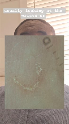 A GP discusses scabies diagnosis and treatment #scabies #primarycare #permethrin #dermatology