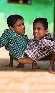 1.7M views · 10K reactions | Incredible, rare conjoined twins ❤️ #reels #viral #borndifferent #disability #conjoinedtwins #compilation #incredible #rare #conjoined #twins #family | Born Different | Facebook