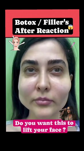 19K views · 15 reactions | What are the side effects of Botox fillers? Possible side effects and unwanted results include: Pain, swelling or bruising at the injection site. Headache or flu-like symptoms. Droopy eyelids or crooked eyebrows. A crooked smile or drooling. Watery or dry eyes. Infection at the injection site. Botox ❌ Fillers ❌ FACEYOGA✅ | Netri Verma | Facebook