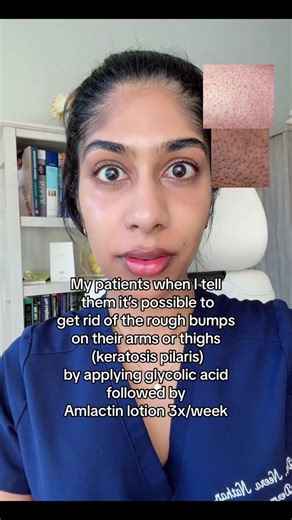 Keratosis pilaris (“strawberry skin” or “chicken skin”) presents as tiny rough bumps on the back of the arms or upper thighs. It appears as red, scaly bumps but can look hyperpigmented on dark skin. It is caused by excess dry skin around the hair follicle. Using products containing exfoliating acids, like glycolic acid toner followed by ammonium lactate lotion (like Amlactin) 3-4x per week can help treat this condition. Make sure to use a moisturizing lotion with ceramides on the other days. #ke