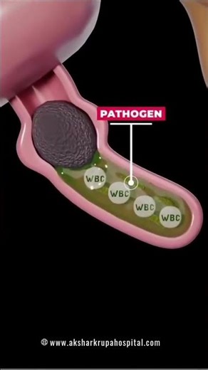 1️⃣ Appendix Removal Surgery in 3D 😲 |#shorts