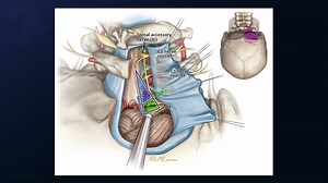 #413: Surgical Techniques of the Far Lateral Craniotomy - All Videos - Seven Series Collection
