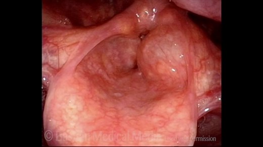 Laryngocele: A Cause of Hoarseness