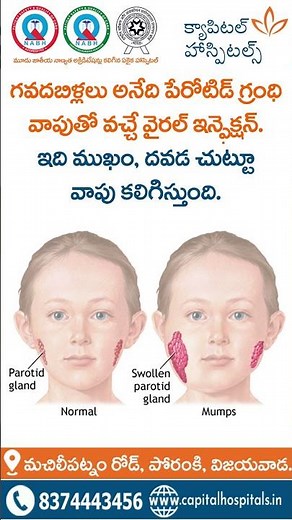 Mumps in Children | Symptoms, Causes, Treatment & Prevention | Capital Hospitals