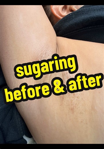 Sugaring is super gentle and highly encouraged for sensitive skin types! I strongly suggest giving it a try if you're struggling with ingrowns, hyperpigmentation, razor burn, and irritation. It's even safe for clients with HS, PCOS, HIRSTUISM, and ECZEMA #sugaring #sugarwax #brazilianwax #hairremoval #fyp