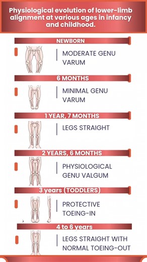 Normal Leg Development in Children Explained | Genu Varum to Genu Valgum 👶🦵
