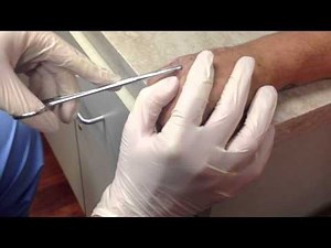 I recently had 2 pins removed from a fractured hand. I was a little confused when the doctor came in with pliers. It's definitely up there on the cringe scale.