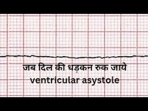 "Understanding Ventricular Asystole | Cardiac Arrest complete guide for nurses Basics"