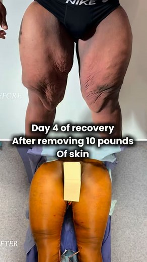 I can’t believe it’s already day four of my skin-surgery recovery. I’ve been resting a lot and sleeping as much as possible. The pain comes and goes, but that’s expected with how much lipo they did. I’m honestly excited to see my legs because I still haven’t looked yet. I’m waiting until the doctor shows me, so I keep my eyes away when they shower me. But even with these tight garments on, I can already feel how much smaller my legs are. #SkinSurgeryJourney #RecoveryProcess #ModifiedMindset | He