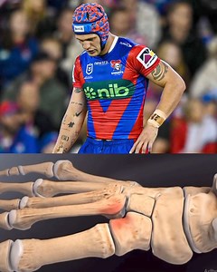 21K views · 127 reactions | Knights confirm that Kalyn Ponga suffered a Lisfranc injury that will require “months, rather than weeks” on the sideline. Overall a complex injury that is one of the more challenging to rehab, often referred to as the “ACL of the foot”. General recovery range: 3-4 months. | NRL Physio | Facebook