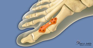 First Metatarsal-phalangeal Joint (MTP ) Arthrodesis