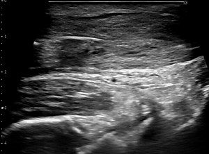Achilles tendon after ultrasound-guided manual therapy