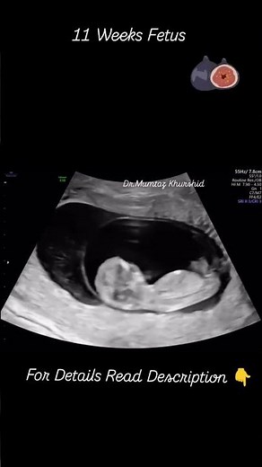 11 Weeks Pregnant: Fetal Development and What to Expect