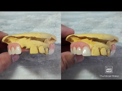 Adding one Central Tooth on Partial Denture| Extracted right central incisor