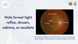Red Reflex and Direct Ophthalmoscope - 红光反射和直接检眼镜