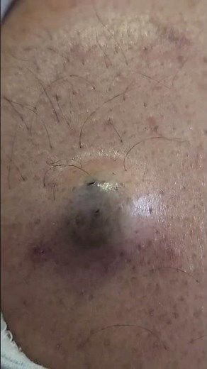 Sebaceous Cyst Swelling #imwell #medicaldoctor #drshashikant