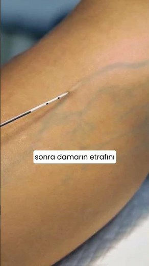 🩺 Lazerle Varis Tedavisi Nedir? Nasıl Uygulanır? | Prof. Dr. Uğur Özkan #ameliyatsızvaristedavisi