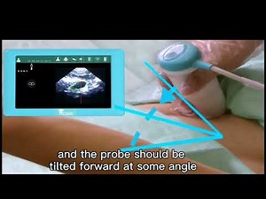 Meike V5.1 Palm Bladder Scanner Training