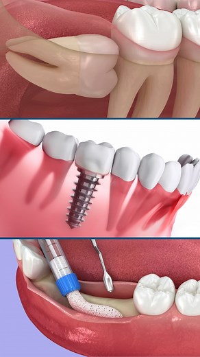 Oral and maxillofacial surgeons like our doctors are highly trained specialists qualified to perform a wide range of surgical procedures involving the mouth, jaws, face, and neck. Their expertise covers both functional and aesthetic aspects, often addressing complex conditions that go beyond the scope of general dentistry. If you need oral surgery, trust the experts at Oral Surgery Associates. Give us a call: 318-388-2621 Visit our website: www.oralsurgeryassociates.com | Oral Surgery Associates