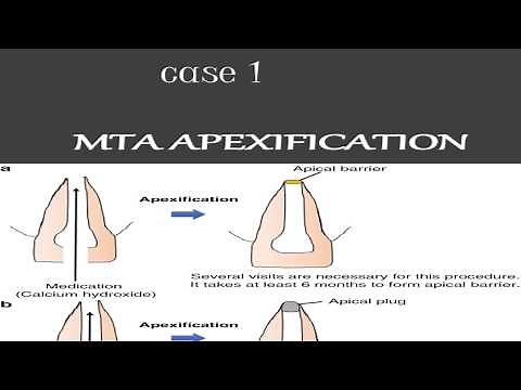 MTA APEXIFICATION case 1 apexification steps