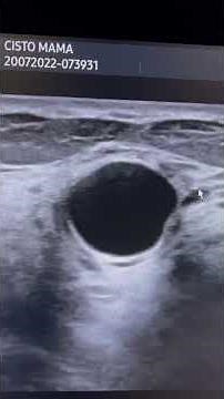 Cyst, benign nodule and breast cancer.