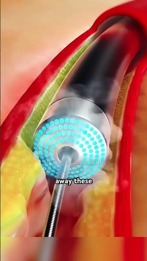 Atherectomy procedure by nano robot. #medicalrobotics #roboticassisted #roboticssurgery #roboticist