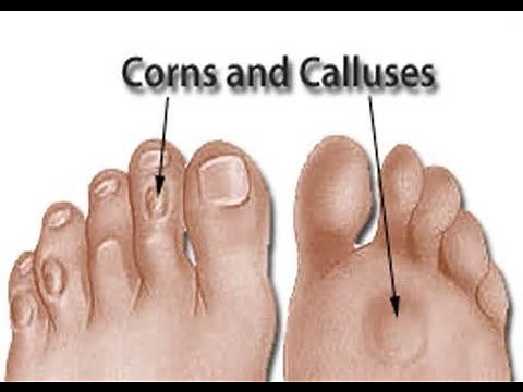 How To Remove Corns/Calluses Using Corn Caps