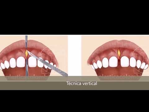 Frenillectomia labial - Procedimientos Orales - Dra. Sandra Nieto