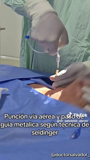 Traqueostomía Percutánea en Cuidados Intensivos