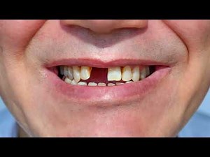 Popular Cosmetic Dental Procedures – How to Get Your Dream Smile