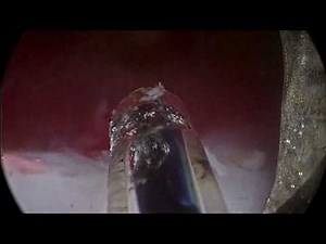 GreenLEP : Enucléation Prostatique par Laser Greenlight