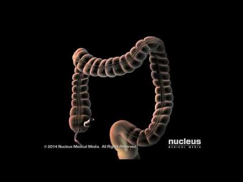 Lower GI Endoscopy at Cook Children's