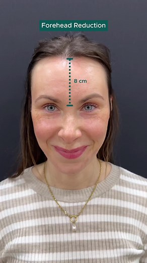 FOREHEAD REDUCTION Our lovely patient came to our clinic from the #Germany 🇩🇪 to have a #foreheadreduction 💆🏻‍♀️ 💫 When our dear patient applied to our clinic, her main problem was having a large forehead, which our measurement of her forehead went along with it 📐 Ideally, the ratio along the hairline, radix, nasal tip and chim tip must be equal to each other ✨ Her forehead length was 8cm and it was unproportioned with her face 📏 ⭐️With forehead reduction surgery 💆🏻‍♀️ we reduced our pa