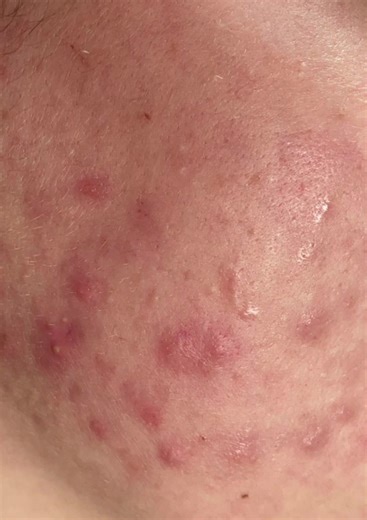 Hablemos un poco del Adapaleno para las pieles con acné #acne #skintexture #adapaleno #differin