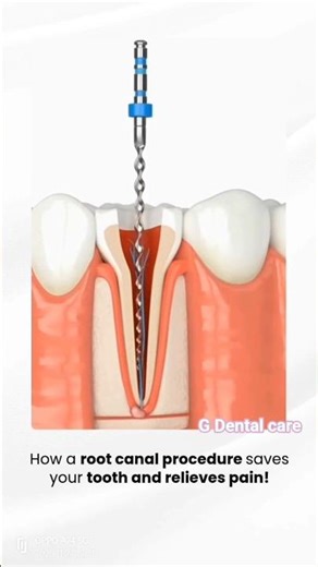 #dental # #shorts #rct #greenscreen #anime #animation