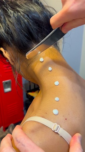 1.3K views |  Instrument Assisted Soft Tissue Mobilization (IASTM) helps break up scar tissue and fascial restrictions using specially designed tools. This technique promotes better circulation, restores mobility, and speeds up recovery from overuse or injury. #IASTM #SoftTissueTherapy #ChicagoChiropractic Chiropractordrkyleross | Chicago Sports Chiropractors | Facebook