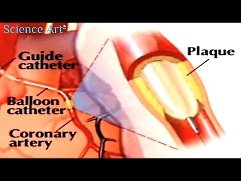 Balloon Angioplasty and Stenting Video Animation - Coronary Angiography and Heart Stent Procedure