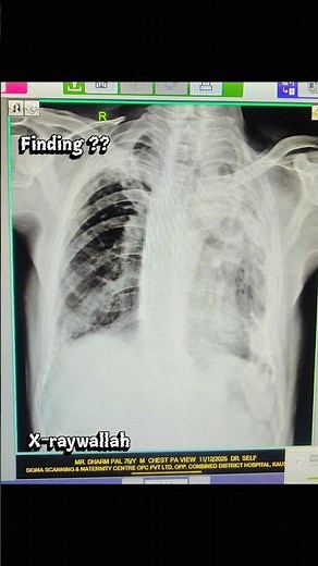 chest xray
