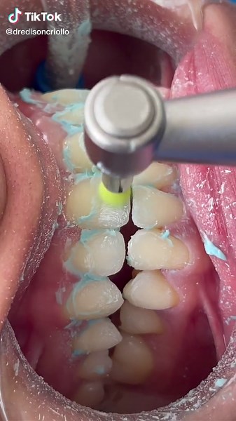 Profilaxis Dental: Beneficios y Procedimientos Esenciales