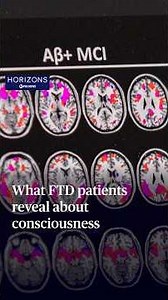 What FTD patients reveal about consciousness