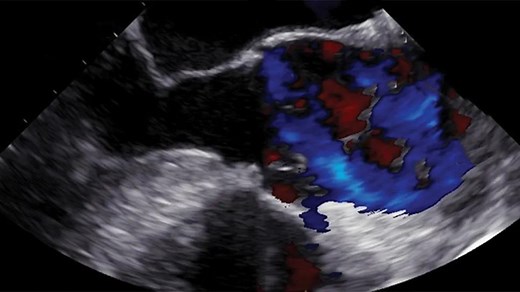 How and Why Intraoperative TEE Is Indispensable to Acute Type A Aortic Dissection Care