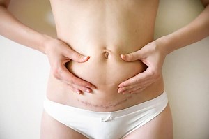 Loose Skin After Pregnancy: What You Can Do About It