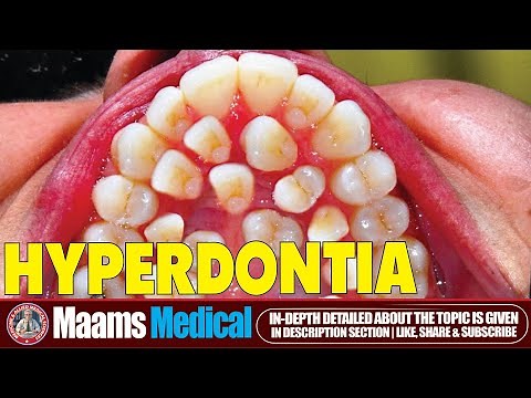 Hyperdontia | Supernumerary Teeth 🦷 | Causes And Treatment | Maams