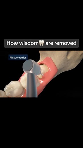 The Process of Removing Wisdom Teeth Explained