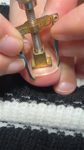 Ingrown Toenail Problem?