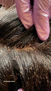 258K views · 2K reactions | Can you see them crawling? Here’s the before and I’ll post the after video tomorrow. Watch how amazing our lice treatment works #viralreelsfacebook #theliceangels #hairtransformation #headlice #piojos #Education #lice #corpuschristi #liceremoval #licequeen #piojocartel #piojogang #love #momlife | The Lice Angels | Facebook