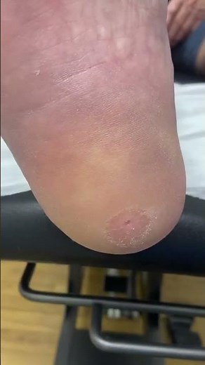 How to Remove Corns from Heel Painlessly: Expert Australian Podiatrist Reveals | Ergonx | Docpods