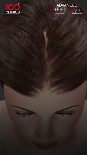 OLT Hair Treatment – Oxygen Laser Therapy for Hair Regrowth 💆‍♂️✨