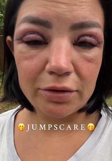 Upper Blepharoplasty Transformation: Before and After