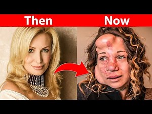 You Won’t Believe How These Celebrities Transformed After Plastic Surgery!